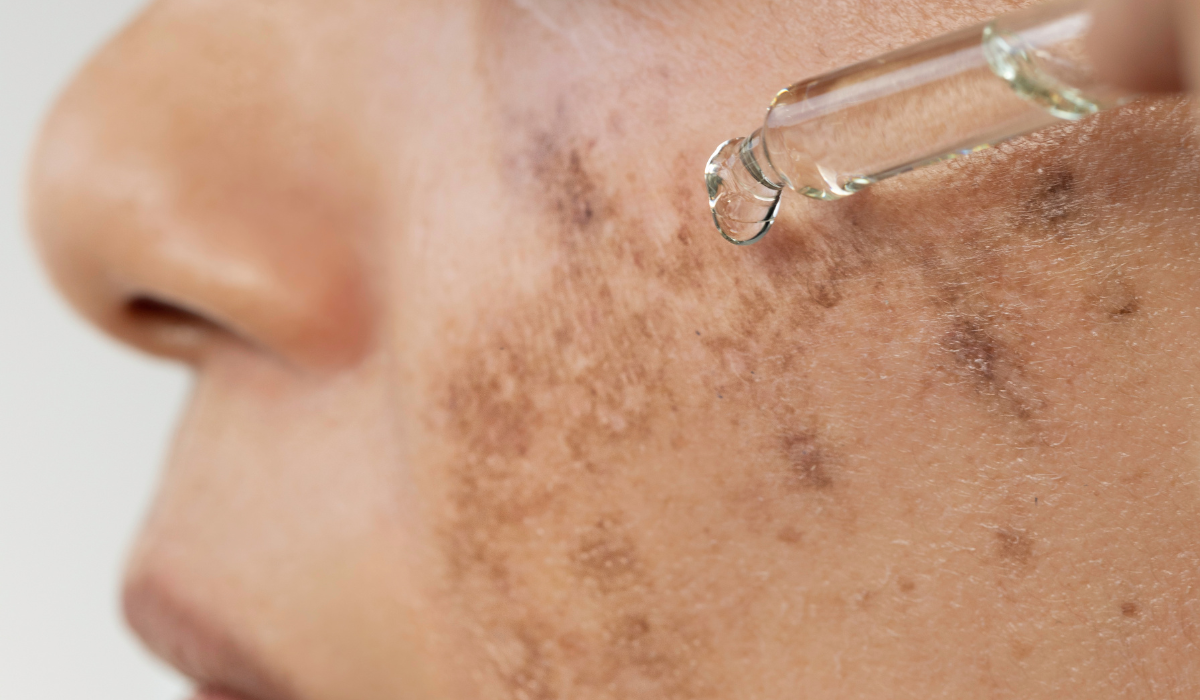 A lady with hyperpigmentation on her face holding a serum dropper against her cheek.