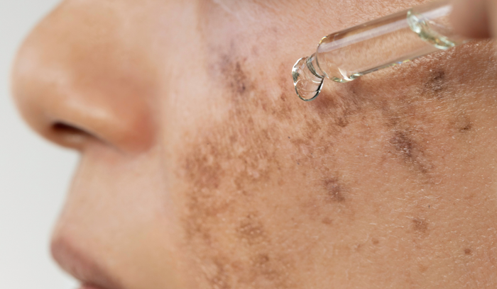 A lady with hyperpigmentation on her face holding a serum dropper against her cheek.